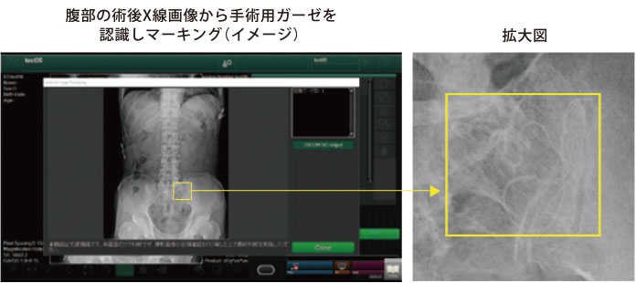 腹部の術後X線画像から手術用ガーゼを認識しマーキング（イメージ）拡大図