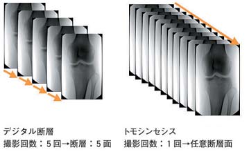 デジタル断層とトモシンセシスの違い