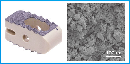 Fig.1 チタンコートPEEK Cage Capstone PTC(Pure Titanium Coating)(Medtronic社)
