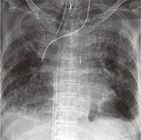 PCPS・CVC・挿管チューブ経鼻胃管の位置確認