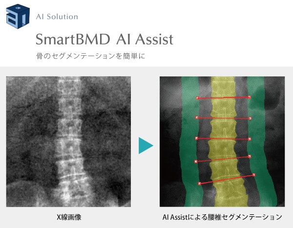 Smart BMD AI Assist