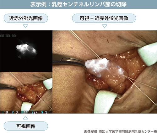 表示例：乳癌センチネルリンパ節の同定