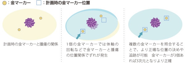 最大3個までの金マーカーに対応し追跡精度を向上