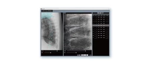 椎体計測ソフトウェア Smart QM